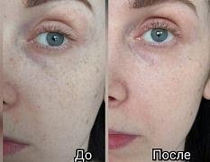 Achroactive Max oqartiruvchi krem