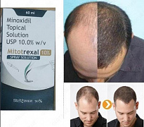 Minoksidil 10% Topikal eritma (Mitotrexal 10%)