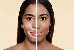 Vitiligo va pigmentatsiya uchun krem ​​